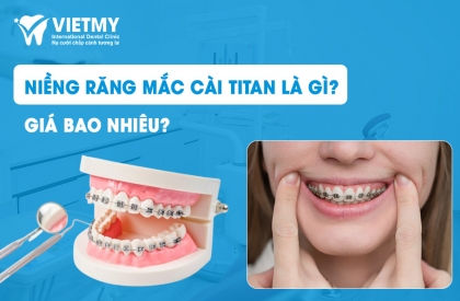 Niềng Răng Mắc Cài Titan Là Gì? Giá Bao Nhiêu Cho Một Nụ Cười Hoàn Hảo?
